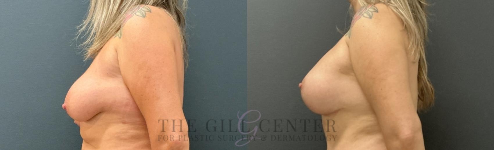 Breast Lift with Implants Case 753 Before & After Left Side | The Woodlands, TX | The Gill Center for Plastic Surgery and Dermatology