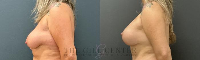 Breast Lift with Implants Case 753 Before & After Left Side | The Woodlands, TX | The Gill Center for Plastic Surgery and Dermatology