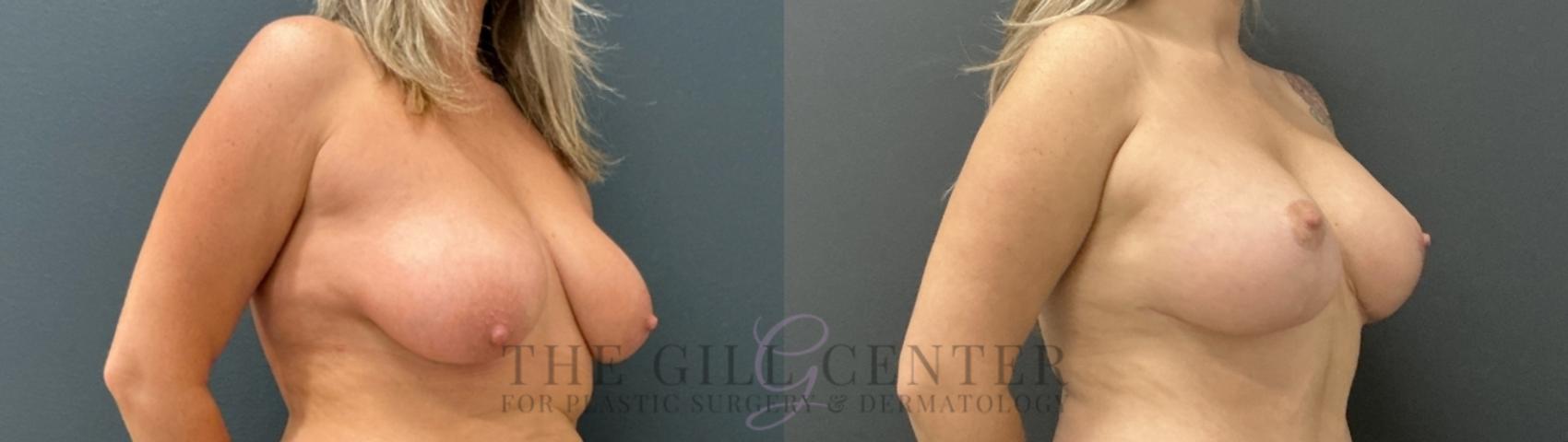 Breast Lift with Implants Case 753 Before & After Right Oblique | The Woodlands, TX | The Gill Center for Plastic Surgery and Dermatology