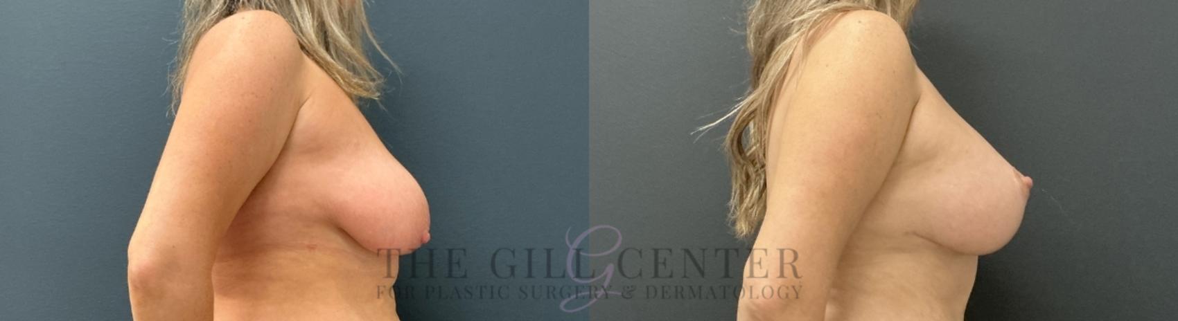 Breast Lift with Implants Case 753 Before & After Right Side | The Woodlands, TX | The Gill Center for Plastic Surgery and Dermatology