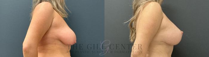 Breast Lift with Implants Case 753 Before & After Right Side | The Woodlands, TX | The Gill Center for Plastic Surgery and Dermatology