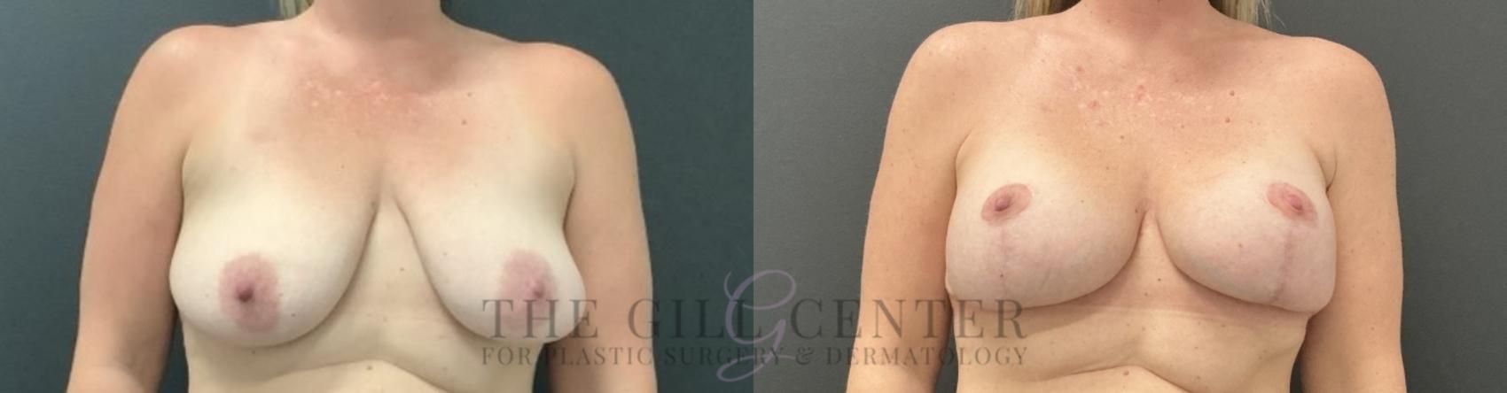 Breast Lift with Implants Case 754 Before & After Front | The Woodlands, TX | The Gill Center for Plastic Surgery and Dermatology