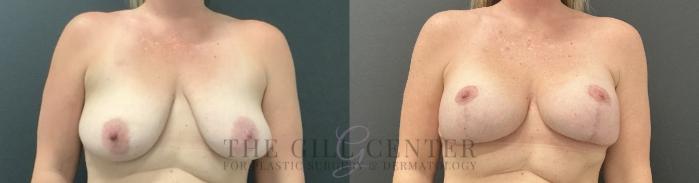 Breast Lift with Implants Case 754 Before & After Front | The Woodlands, TX | The Gill Center for Plastic Surgery and Dermatology