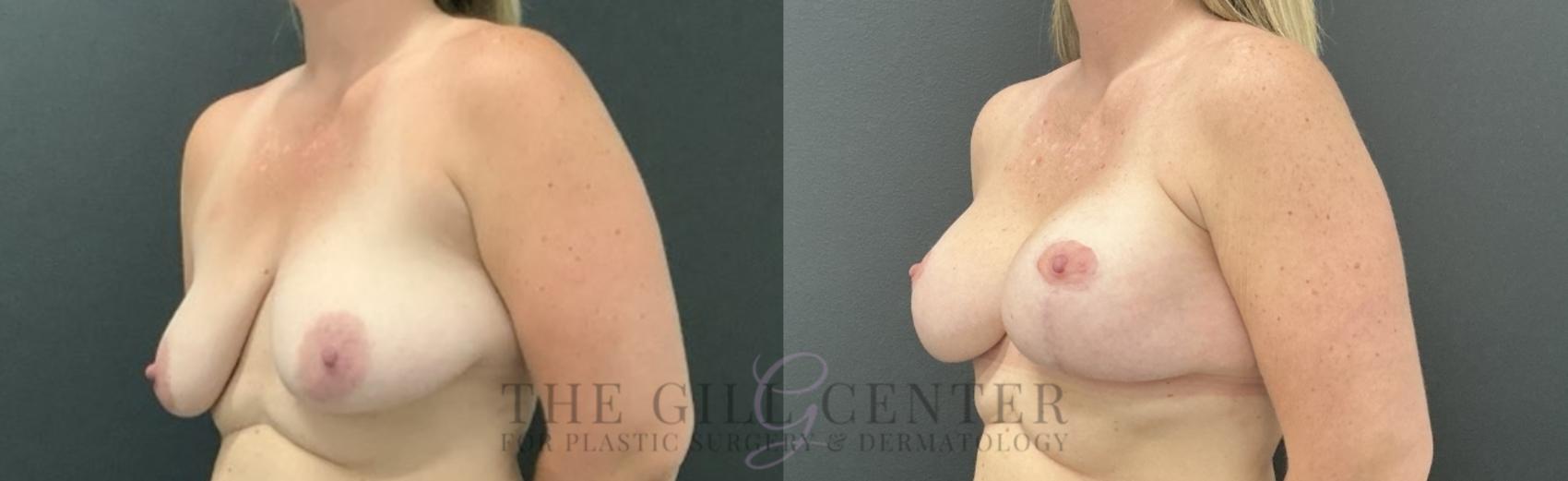 Breast Lift with Implants Case 754 Before & After Left Oblique | The Woodlands, TX | The Gill Center for Plastic Surgery and Dermatology