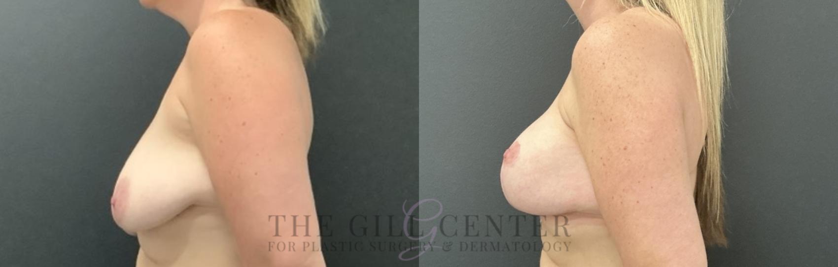 Breast Lift with Implants Case 754 Before & After Left Side | The Woodlands, TX | The Gill Center for Plastic Surgery and Dermatology