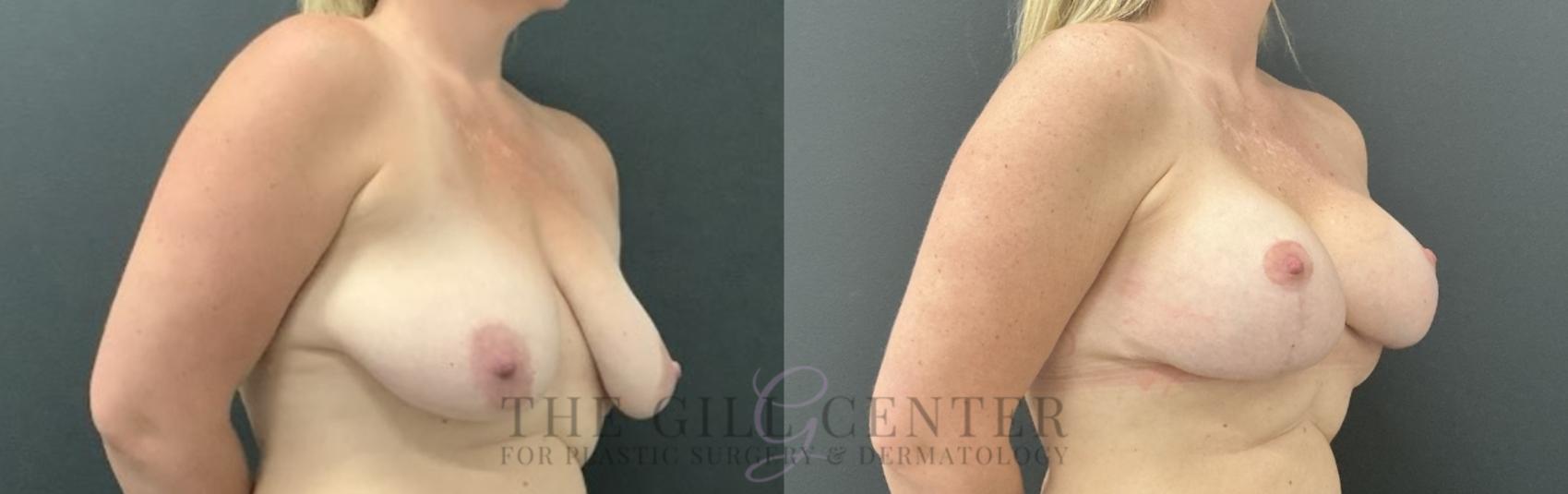 Breast Lift with Implants Case 754 Before & After Right Oblique | The Woodlands, TX | The Gill Center for Plastic Surgery and Dermatology