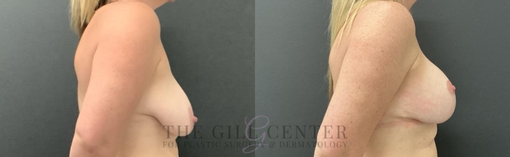 Breast Lift with Implants Case 754 Before & After Right Side | The Woodlands, TX | The Gill Center for Plastic Surgery and Dermatology
