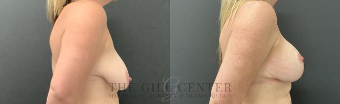 Breast Lift with Implants Case 754 Before & After Right Side | The Woodlands, TX | The Gill Center for Plastic Surgery and Dermatology