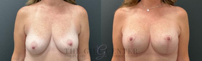 Breast Lift with Implants Case 764 Before & After Front | The Woodlands, TX | The Gill Center for Plastic Surgery and Dermatology