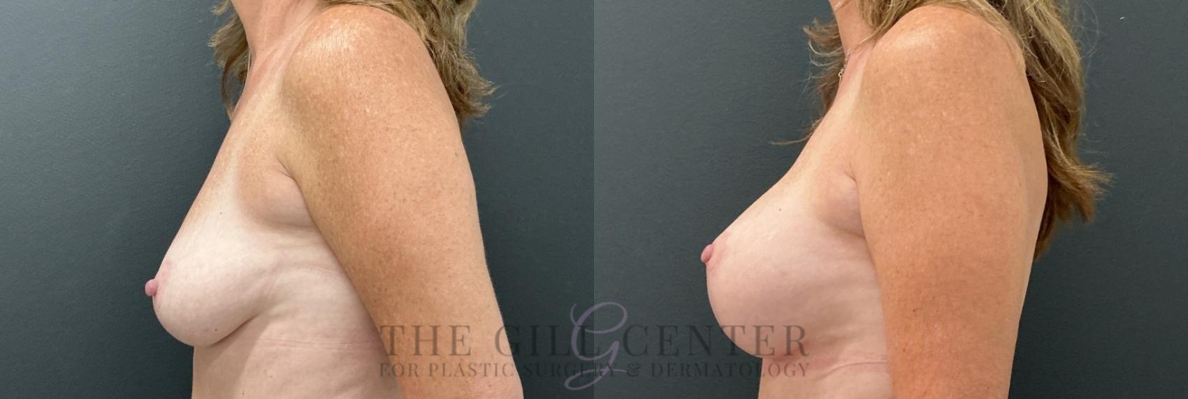 Breast Lift with Implants Case 764 Before & After Left Side | The Woodlands, TX | The Gill Center for Plastic Surgery and Dermatology