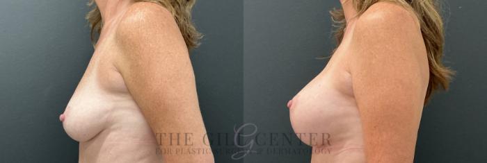 Breast Lift with Implants Case 764 Before & After Left Side | The Woodlands, TX | The Gill Center for Plastic Surgery and Dermatology