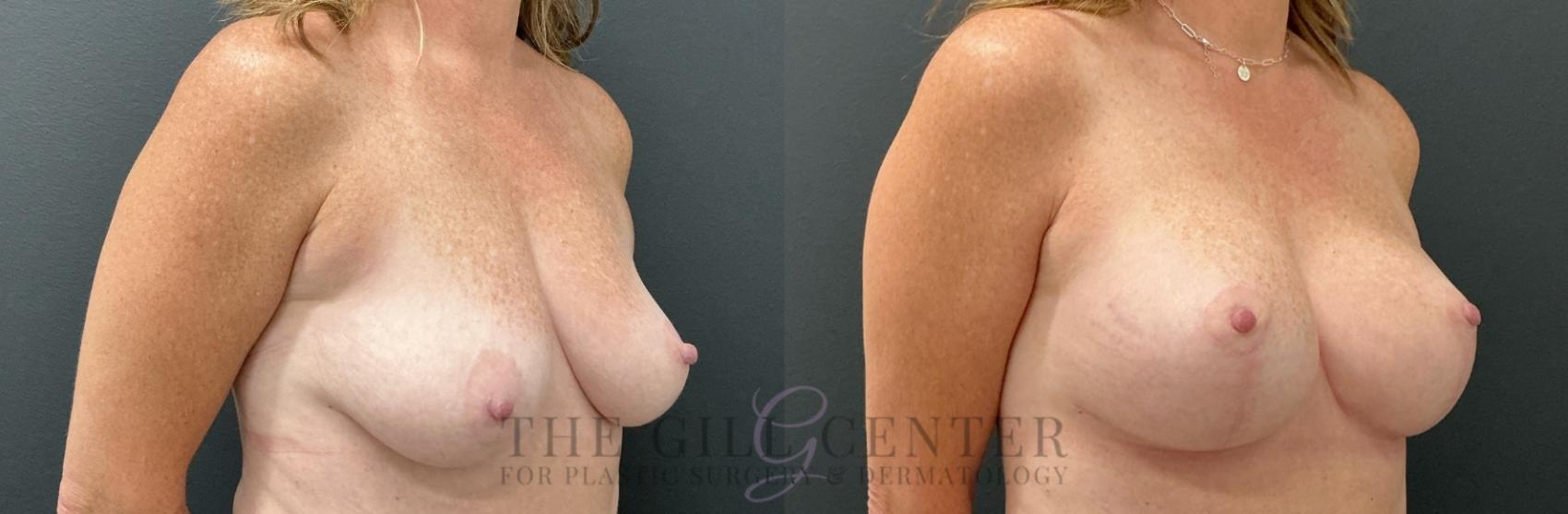 Breast Lift with Implants Case 764 Before & After Right Oblique | The Woodlands, TX | The Gill Center for Plastic Surgery and Dermatology