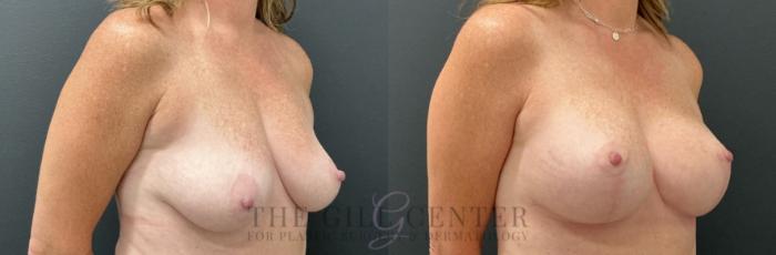 Breast Lift with Implants Case 764 Before & After Right Oblique | The Woodlands, TX | The Gill Center for Plastic Surgery and Dermatology