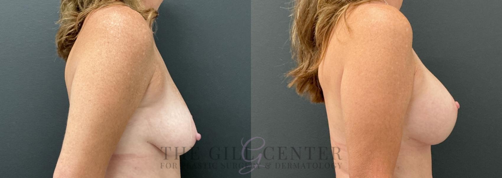 Breast Lift with Implants Case 764 Before & After Right Side | The Woodlands, TX | The Gill Center for Plastic Surgery and Dermatology