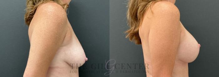 Breast Lift with Implants Case 764 Before & After Right Side | The Woodlands, TX | The Gill Center for Plastic Surgery and Dermatology