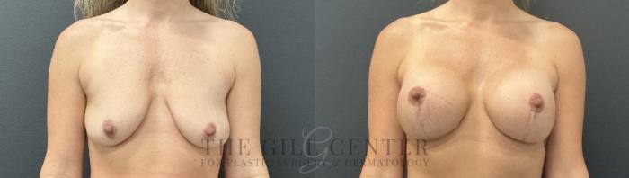 Breast Lift with Implants Case 767 Before & After Front | The Woodlands, TX | The Gill Center for Plastic Surgery and Dermatology