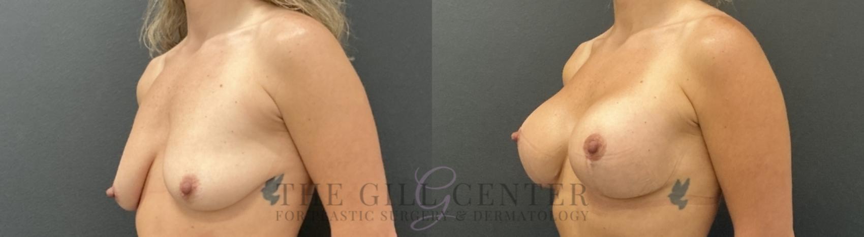 Breast Lift with Implants Case 767 Before & After Left Oblique | The Woodlands, TX | The Gill Center for Plastic Surgery and Dermatology
