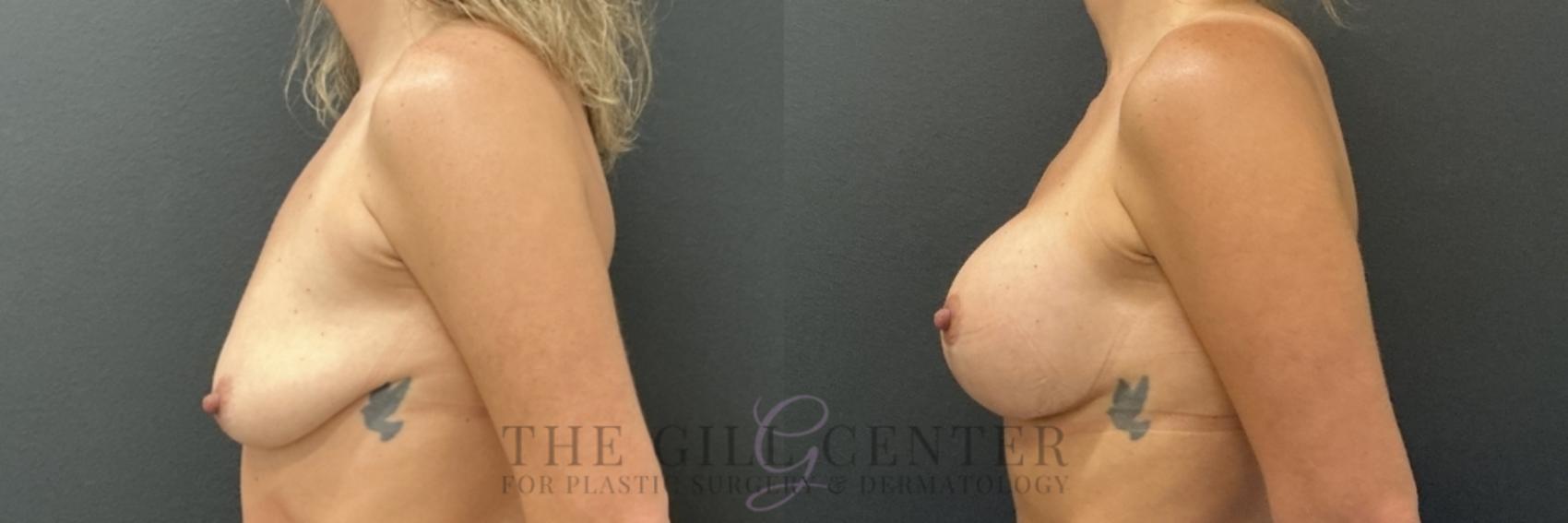 Breast Lift with Implants Case 767 Before & After Left Side | The Woodlands, TX | The Gill Center for Plastic Surgery and Dermatology