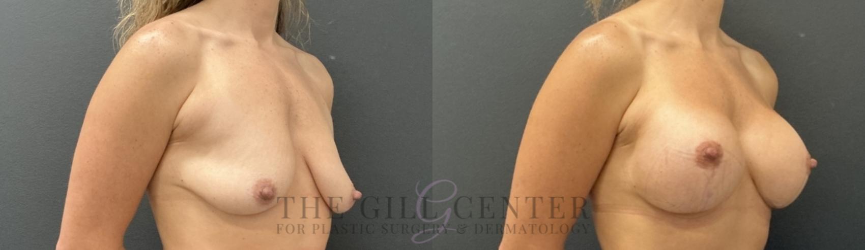Breast Lift with Implants Case 767 Before & After Right Oblique | The Woodlands, TX | The Gill Center for Plastic Surgery and Dermatology