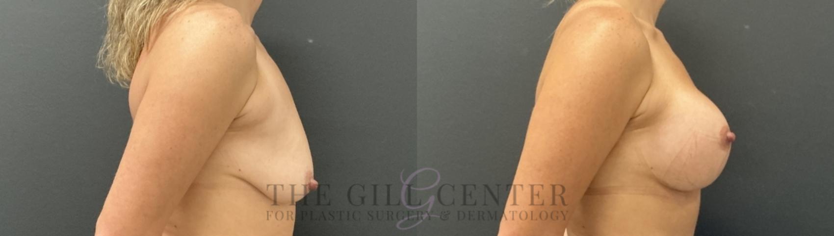 Breast Lift with Implants Case 767 Before & After Right Side | The Woodlands, TX | The Gill Center for Plastic Surgery and Dermatology