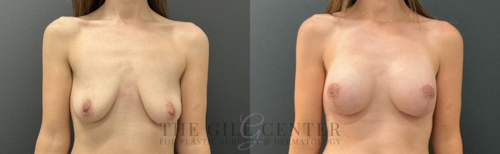 Breast Lift with Implants Case 790 Before & After Front | The Woodlands, TX | The Gill Center for Plastic Surgery and Dermatology