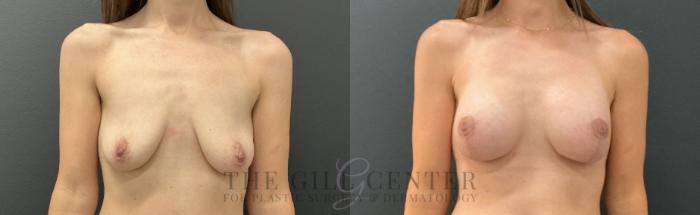 Breast Lift with Implants Case 790 Before & After Front | The Woodlands, TX | The Gill Center for Plastic Surgery and Dermatology