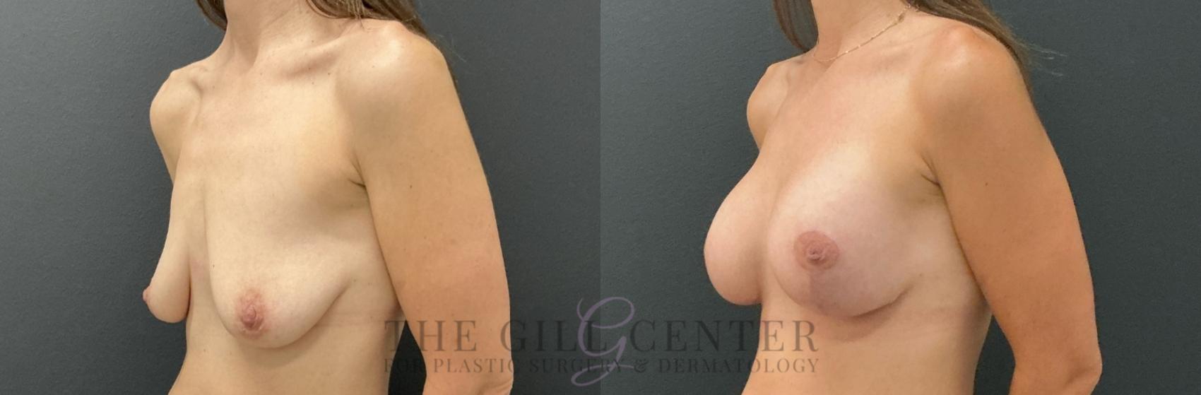 Breast Lift with Implants Case 790 Before & After Left Oblique | The Woodlands, TX | The Gill Center for Plastic Surgery and Dermatology