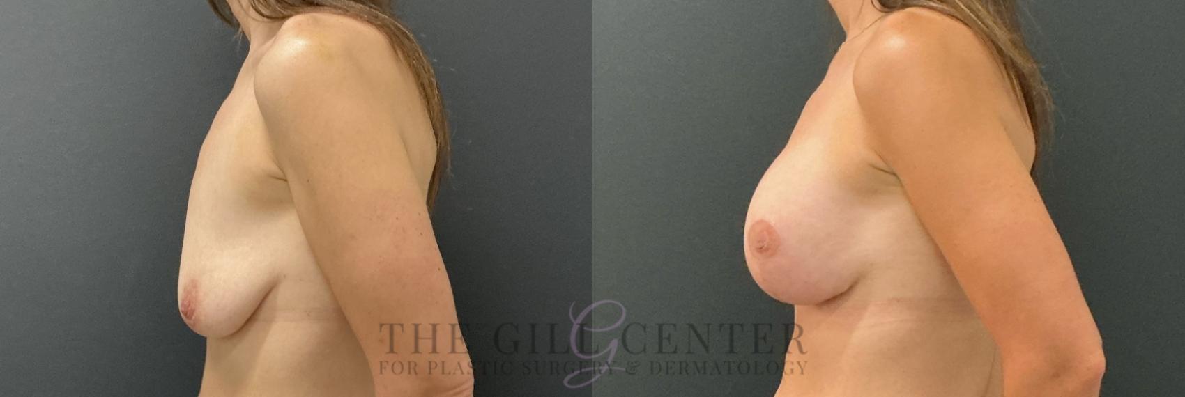 Breast Lift with Implants Case 790 Before & After Left Side | The Woodlands, TX | The Gill Center for Plastic Surgery and Dermatology