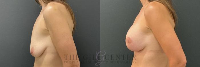 Breast Lift with Implants Case 790 Before & After Left Side | The Woodlands, TX | The Gill Center for Plastic Surgery and Dermatology