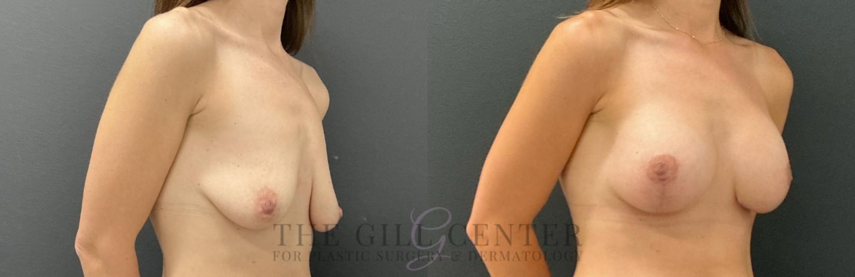 Breast Lift with Implants Case 790 Before & After Right Oblique | The Woodlands, TX | The Gill Center for Plastic Surgery and Dermatology