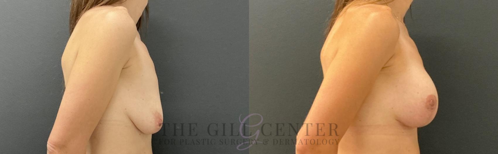 Breast Lift with Implants Case 790 Before & After Right Side | The Woodlands, TX | The Gill Center for Plastic Surgery and Dermatology