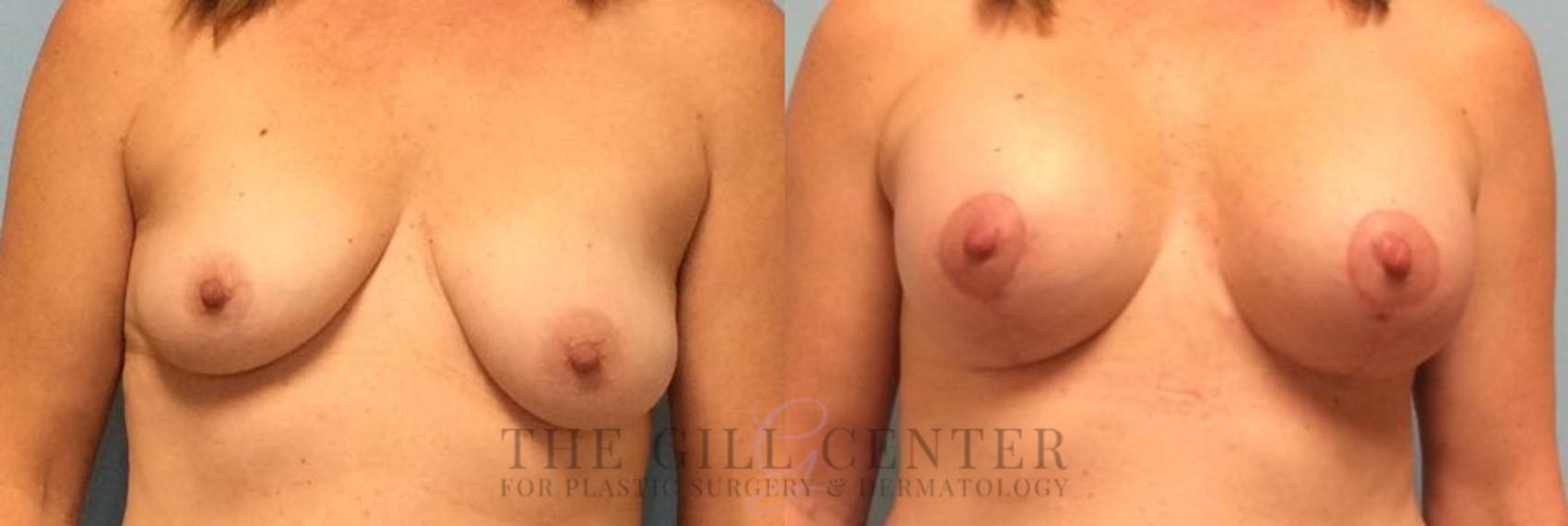 Breast Lift with Implants Case 92 Before & After Front | The Woodlands, TX | The Gill Center for Plastic Surgery and Dermatology