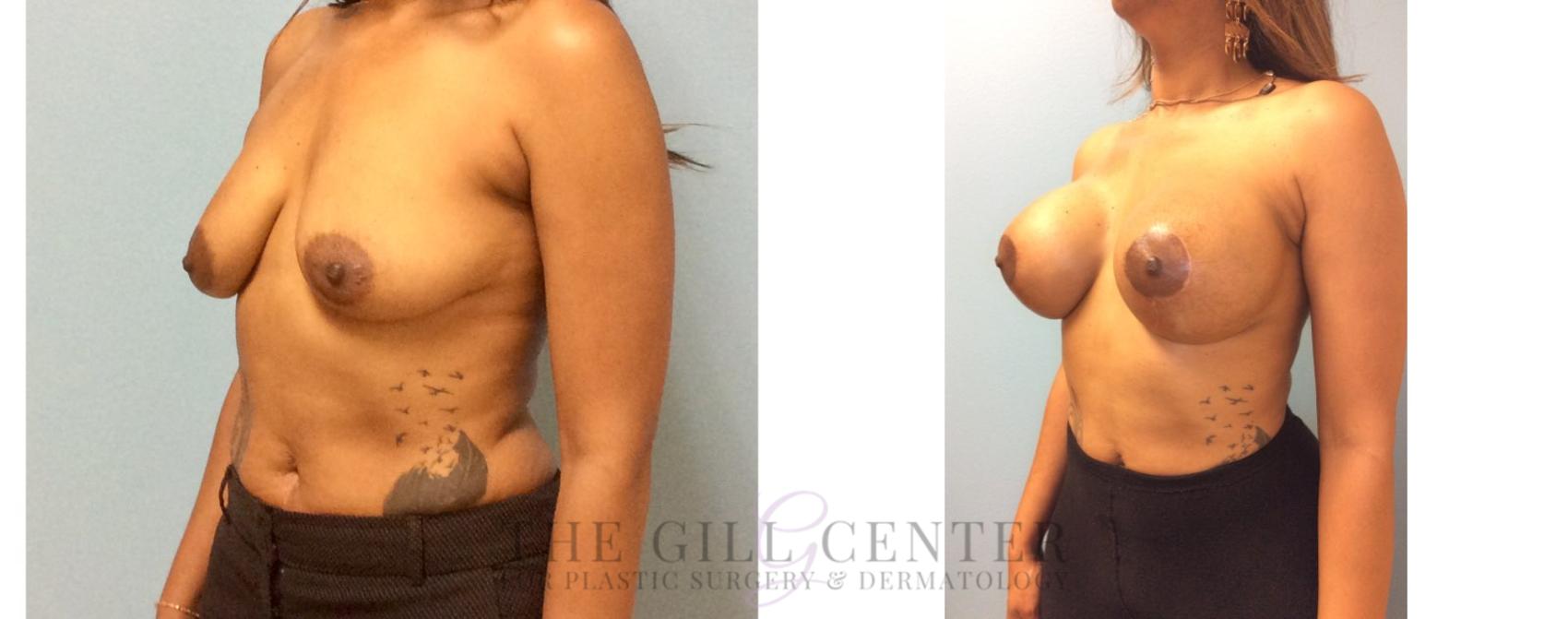 Breast Lift with Implants Case 93 Before & After Left Oblique | The Woodlands, TX | The Gill Center for Plastic Surgery and Dermatology