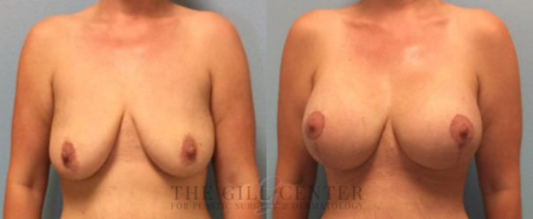 Breast Lift with Implants Case 95 Before & After Front | The Woodlands, TX | The Gill Center for Plastic Surgery and Dermatology