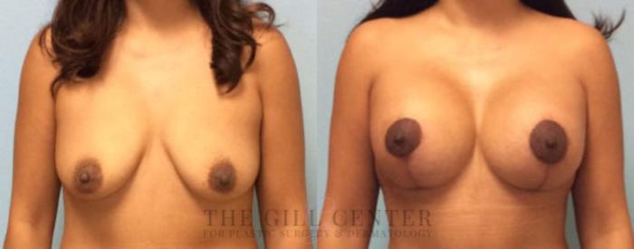 Breast Lift with Implants Case 96 Before & After Front | The Woodlands, TX | The Gill Center for Plastic Surgery and Dermatology
