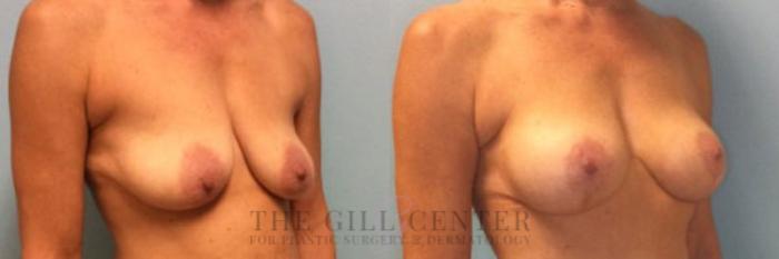 Breast Lift with Implants Case 97 Before & After Right Oblique | The Woodlands, TX | The Gill Center for Plastic Surgery and Dermatology