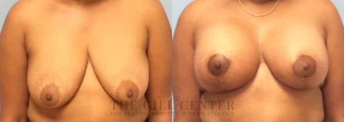Breast Lift with Implants Case 98 Before & After Front | The Woodlands, TX | The Gill Center for Plastic Surgery and Dermatology