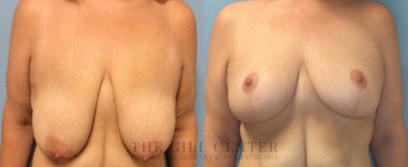 Breast Reduction Case 123 Before & After Front | The Woodlands, TX | The Gill Center for Plastic Surgery and Dermatology