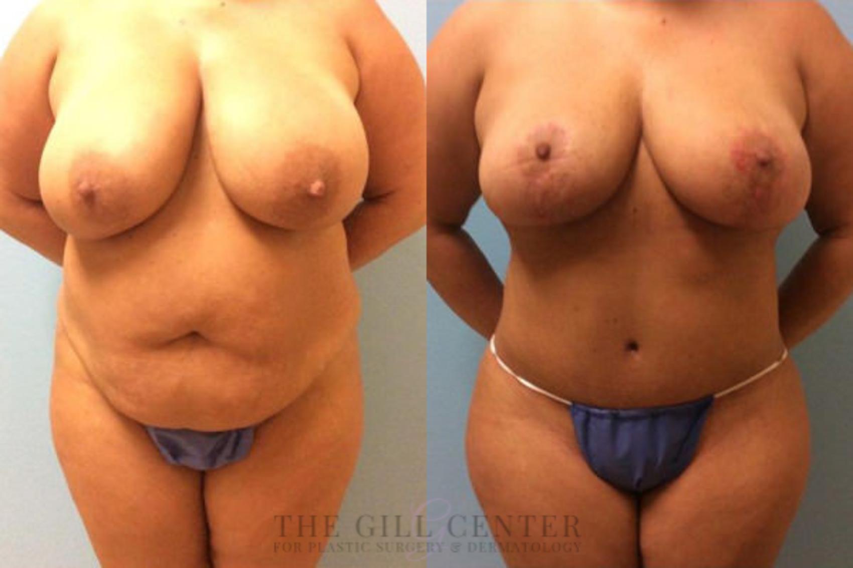 Breast Reduction Case 124 Before & After Front | The Woodlands, TX | The Gill Center for Plastic Surgery and Dermatology