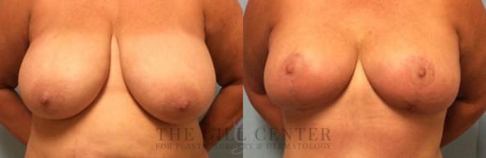 Breast Reduction Case 125 Before & After Front | The Woodlands, TX | The Gill Center for Plastic Surgery and Dermatology
