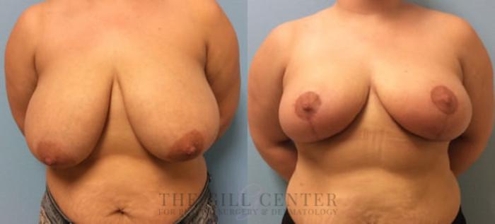 Breast Reduction Case 126 Before & After Front | The Woodlands, TX | The Gill Center for Plastic Surgery and Dermatology