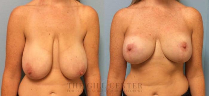 Breast Reduction Case 127 Before & After Front | The Woodlands, TX | The Gill Center for Plastic Surgery and Dermatology