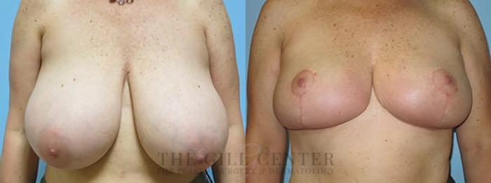 Breast Reduction Case 128 Before & After Front | The Woodlands, TX | The Gill Center for Plastic Surgery and Dermatology