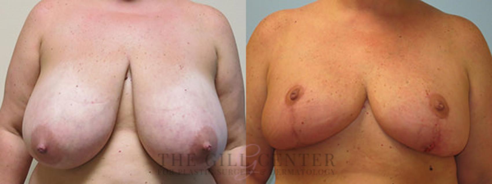 Breast Reduction Case 129 Before & After Front | The Woodlands, TX | The Gill Center for Plastic Surgery and Dermatology