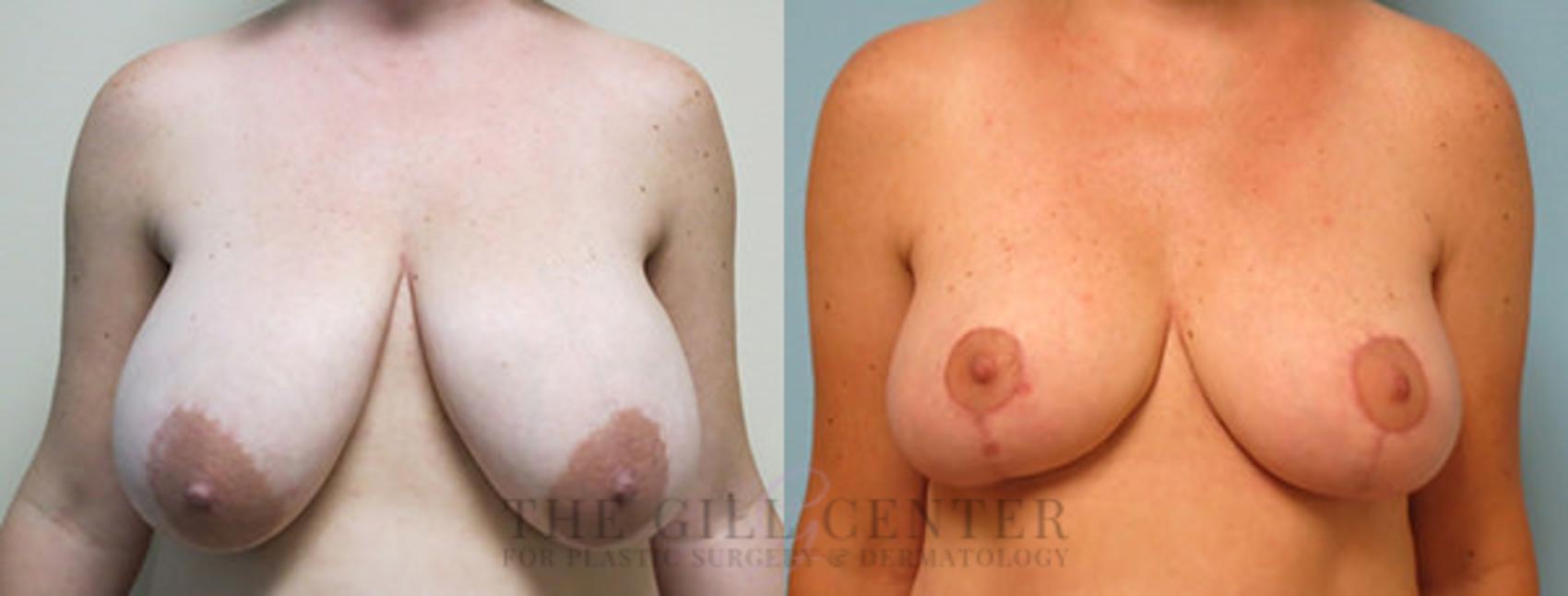 Breast Reduction Case 130 Before & After Front | The Woodlands, TX | The Gill Center for Plastic Surgery and Dermatology