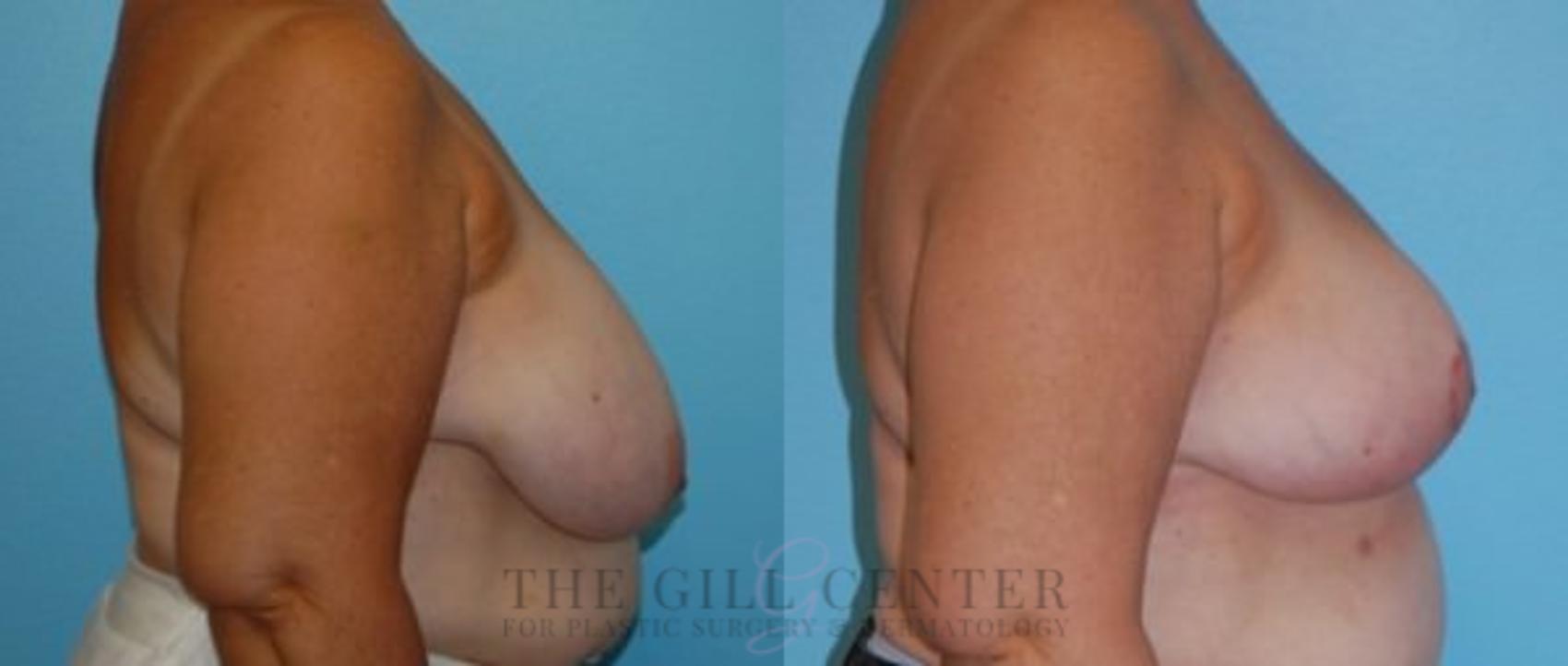 Breast Reduction Case 131 Before & After Right Side | The Woodlands, TX | The Gill Center for Plastic Surgery and Dermatology