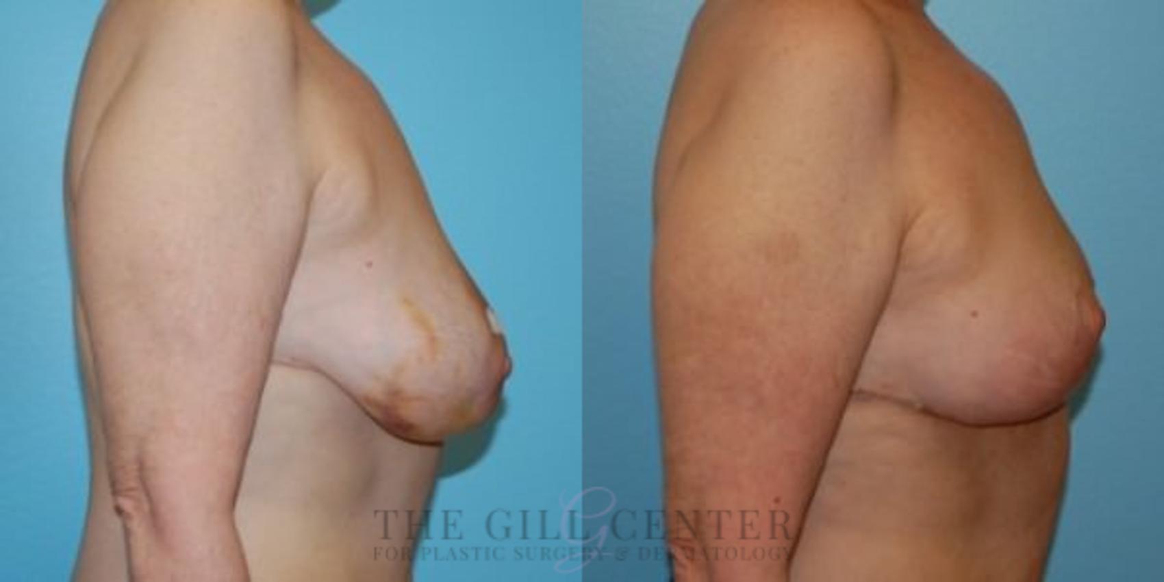 Breast Reduction Case 132 Before & After Right Side | The Woodlands, TX | The Gill Center for Plastic Surgery and Dermatology