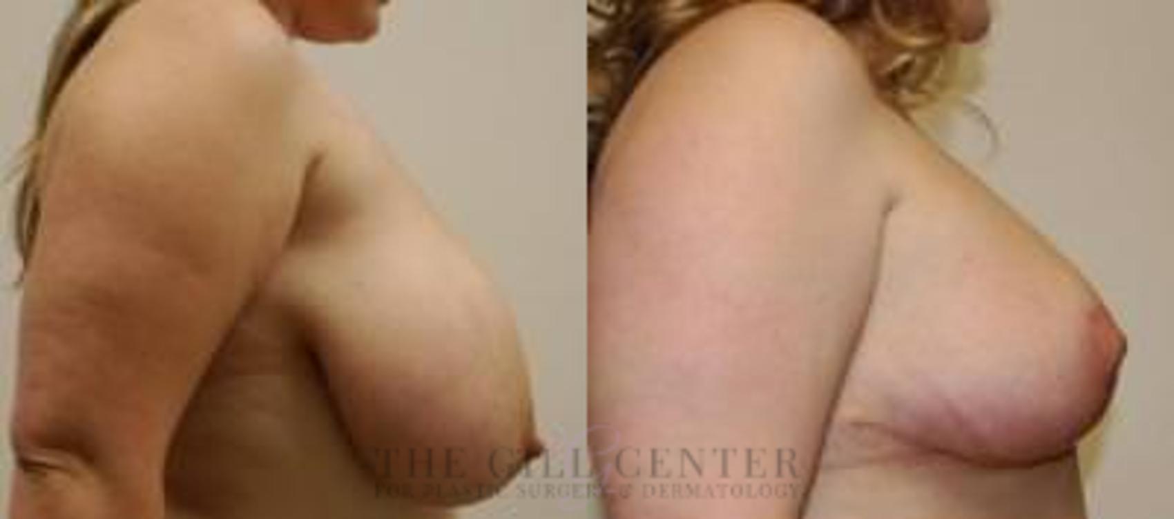 Breast Reduction Case 133 Before & After Right Side | The Woodlands, TX | The Gill Center for Plastic Surgery and Dermatology