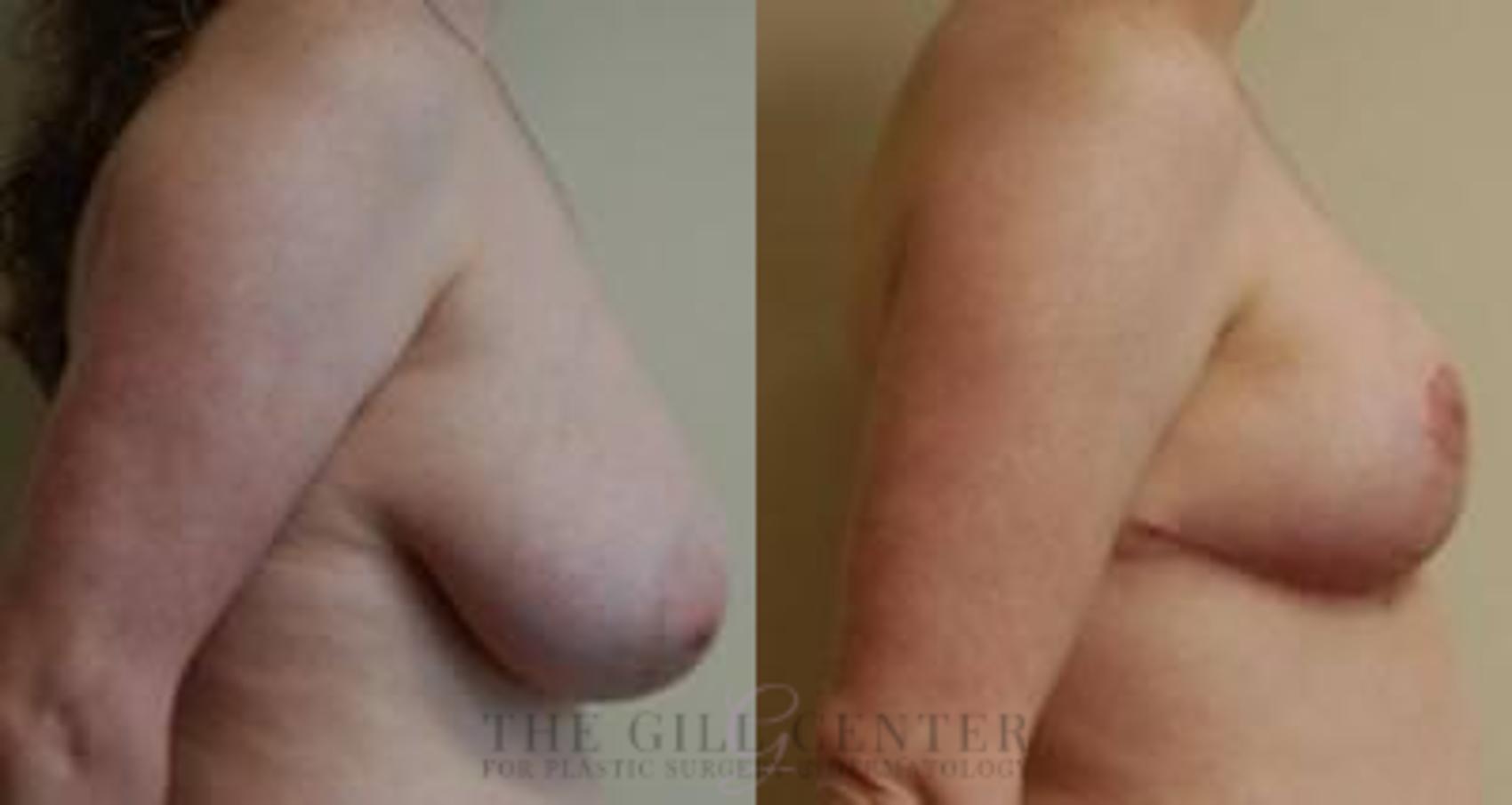 Breast Reduction Case 134 Before & After Right Side | The Woodlands, TX | The Gill Center for Plastic Surgery and Dermatology