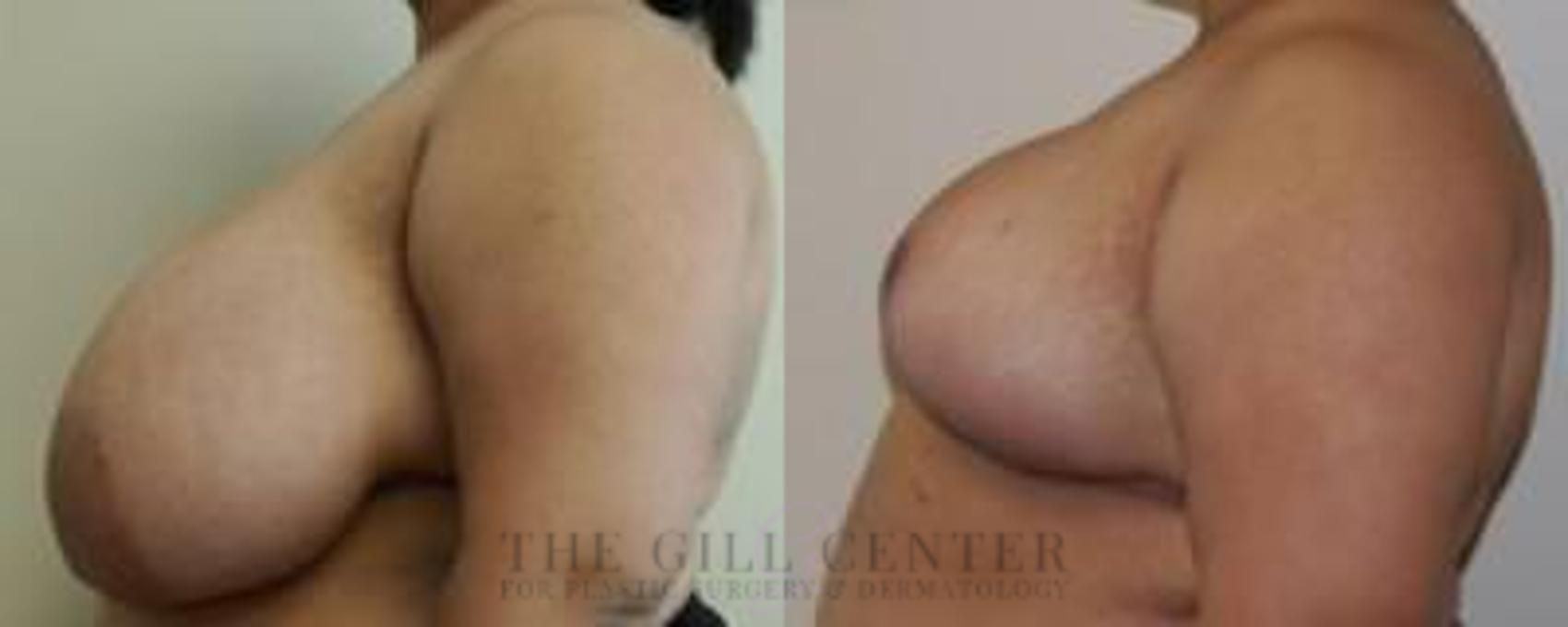 Breast Reduction Case 135 Before & After Left Side | The Woodlands, TX | The Gill Center for Plastic Surgery and Dermatology